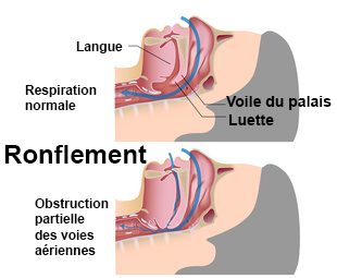 Le ronflement